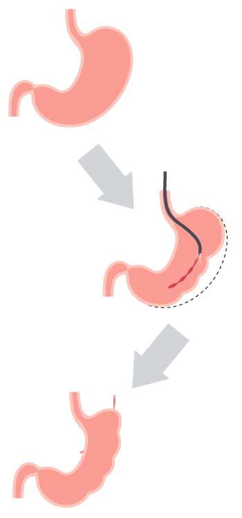 Endoscopic-Sleeve-Gastroplasty